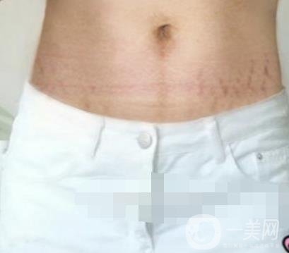 汾陽醫(yī)院美容整形科祛妊娠紋怎么樣？手術(shù)項(xiàng)目收費(fèi)價(jià)格表和案例一覽