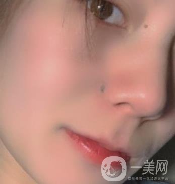 黃岡市中心醫(yī)院美容整形科祛痣多少錢？價格費用表和*果圖精選
