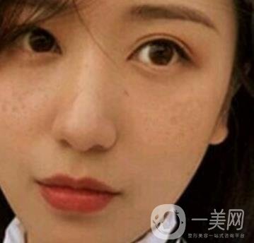 荊州市第三人民醫(yī)院整形美容科*祛斑*果好嗎？收費(fèi)價(jià)格明細(xì)表一覽
