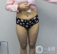 武漢市武昌醫(yī)院整形美容科價格表和吸脂瘦大腿案例精選圖公布
