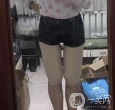 武漢市武昌醫(yī)院整形美容科價格表和吸脂瘦大腿案例精選圖公布