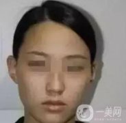 湖南省人民醫(yī)院點(diǎn)陣激光祛斑價格表及案例分享