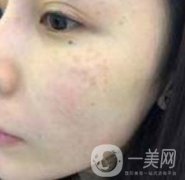 蘇州附一醫(yī)院可以激光祛斑嗎？案例圖及整形價格表分享