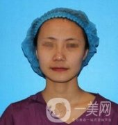 昆明惟美整形醫(yī)院脂肪填充全臉價(jià)格表和案例
