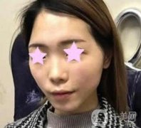 北大醫(yī)院整形美容科價格表，自體脂肪填充面部果怎么樣