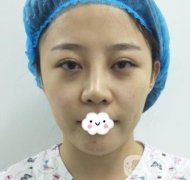 玫瑰醫(yī)院整形美容價格表，自體脂肪填充面部前后圖