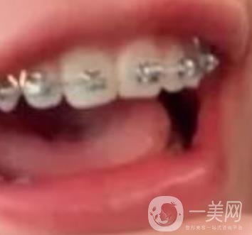 龍崗中心醫(yī)院整牙多少錢？?jī)r(jià)格表2020收費(fèi)明細(xì)公開一覽