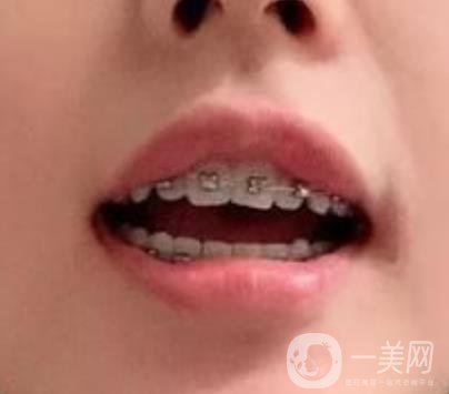 龍崗中心醫(yī)院整牙多少錢？?jī)r(jià)格表2020收費(fèi)明細(xì)公開一覽