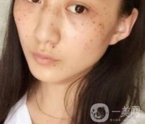 安醫(yī)一附院整形外科價格表2020版，還有激光祛斑案例