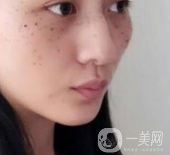 安醫(yī)一附院整形外科價(jià)格表2020版，還有激光祛斑案例