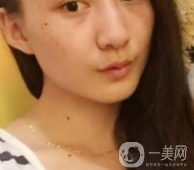 安醫(yī)一附院整形外科價(jià)格表2020版，還有激光祛斑案例