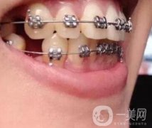 北京市海淀醫(yī)院口腔科價格表2020更新，附牙齒矯正案例