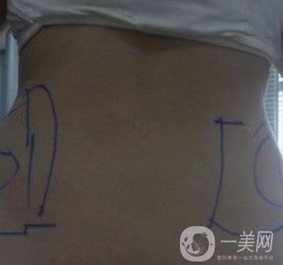 襄陽(yáng)市第一人民醫(yī)院整形美容科吸脂瘦肚子多少錢(qián)？?jī)r(jià)格表整形日記一覽