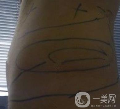 襄陽(yáng)市第一人民醫(yī)院整形美容科吸脂瘦肚子多少錢(qián)？?jī)r(jià)格表整形日記一覽