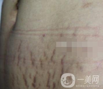 陽煤集團總醫(yī)院整形美容科祛妊娠紋恢復(fù)記錄，內(nèi)附價格表