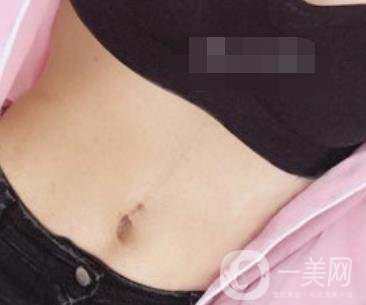 陽煤集團總醫(yī)院整形美容科祛妊娠紋恢復(fù)記錄，內(nèi)附價格表