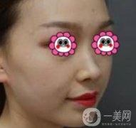 沈陽杏林崔昌墉做鼻子怎么樣？2020整形價(jià)格表一覽