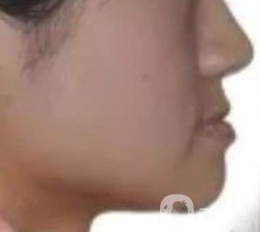 鄭大一附院口腔正畸怎么樣?附項(xiàng)目價(jià)格表及案例圖