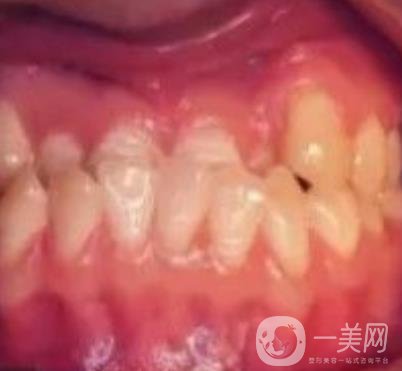 鄭大一附院口腔正畸怎么樣?附項(xiàng)目價(jià)格表及案例圖