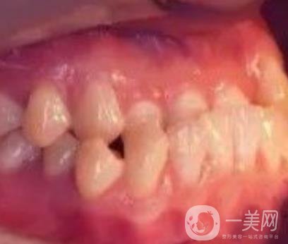 鄭大一附院口腔正畸怎么樣?附項(xiàng)目價(jià)格表及案例圖