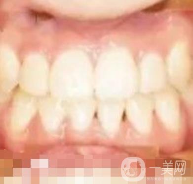 鄭大一附院口腔正畸怎么樣?附項(xiàng)目價(jià)格表及案例圖