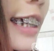 桂林美奧口腔醫(yī)院價(jià)格表全新版，附牙齒矯正案例