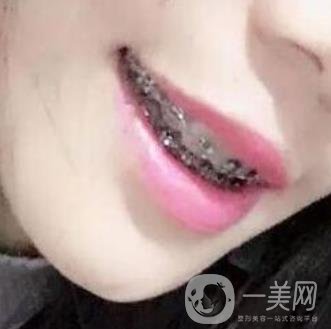 桂林美奧口腔醫(yī)院價格表全新版，附牙齒矯正案例