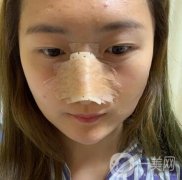 重慶新橋醫(yī)院整形科價(jià)格表，隆鼻案例分享