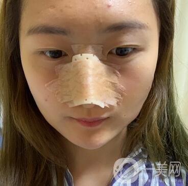 重慶新橋醫(yī)院整形科價格表，隆鼻案例分享