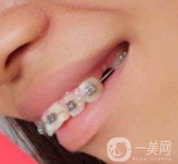 復(fù)旦大學(xué)附屬兒科醫(yī)院口腔科做牙齒矯正多少錢？?jī)r(jià)格表明細(xì)一覽