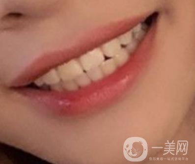 復(fù)旦大學(xué)附屬兒科醫(yī)院口腔科做牙齒矯正多少錢？?jī)r(jià)格表明細(xì)一覽