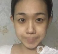 重慶醫(yī)科大學(xué)附屬第一醫(yī)院整形科價(jià)格價(jià)目表，附雙眼皮果圖