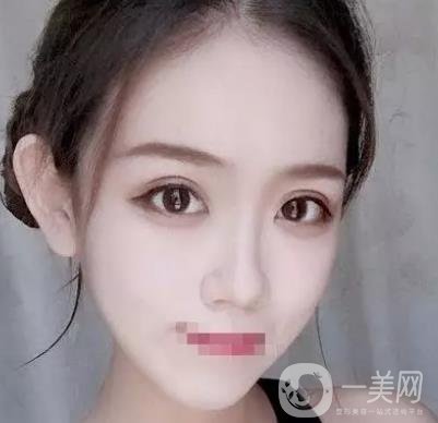 重慶醫(yī)科大學(xué)附屬第一醫(yī)院整形科價(jià)格價(jià)目表，附雙眼皮*果圖