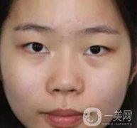 淮安第一人民醫(yī)院割雙眼皮怎樣？真人案例及整形價(jià)格表分享