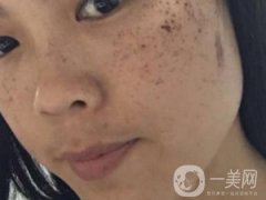 北京星美整形醫(yī)院祛斑如何？附案例和價格表