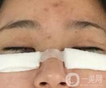 協(xié)和醫(yī)院整形美容科價(jià)格表，附去眼袋手術(shù)果圖分享