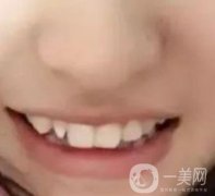 良鄉(xiāng)優(yōu)貝口腔醫(yī)院價(jià)格表，整牙恢復(fù)前后照