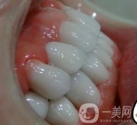 杭州格萊美醫(yī)院整牙價(jià)格表，看牙齒矯正術(shù)后果實(shí)拍