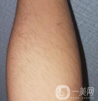 哈醫(yī)大四院整形美容科價(jià)格表鉅惠來襲，附冰點(diǎn)脫毛案例