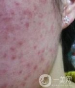 成都軍區(qū)總醫(yī)院整形美容科價(jià)格表及祛痘印真人日記