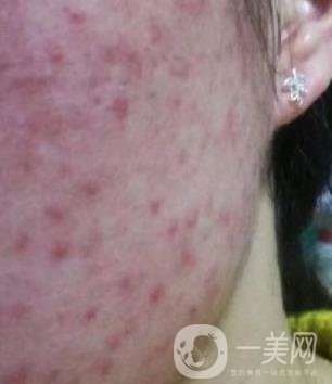 成都軍區(qū)總醫(yī)院整形美容科價(jià)格表及祛痘印真人日記