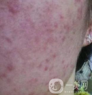 成都軍區(qū)總醫(yī)院整形美容科價(jià)格表及祛痘印真人日記
