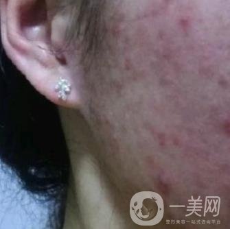 成都軍區(qū)總醫(yī)院整形美容科價(jià)格表及祛痘印真人日記