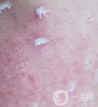 成都軍區(qū)總醫(yī)院整形美容科價(jià)格表及祛痘印真人日記
