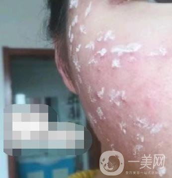 成都軍區(qū)總醫(yī)院整形美容科價(jià)格表及祛痘印真人日記