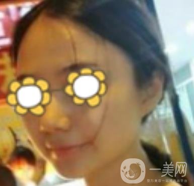 阜陽市人民醫(yī)院整形美容科價格表2020版，附*案例
