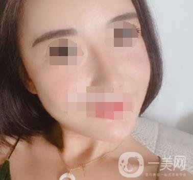 哈爾濱醫(yī)大二院整形美容科價(jià)格表上線，附*案例