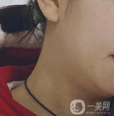河南省人民醫(yī)院整形美容科價(jià)格表公布，附除腋臭案例