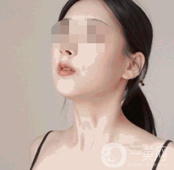 河南省人民醫(yī)院整形美容科價(jià)格表公布，附除腋臭案例