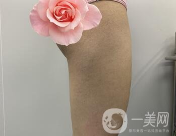 邢臺(tái)人民醫(yī)院整形美容科價(jià)格表，附大腿吸脂案例